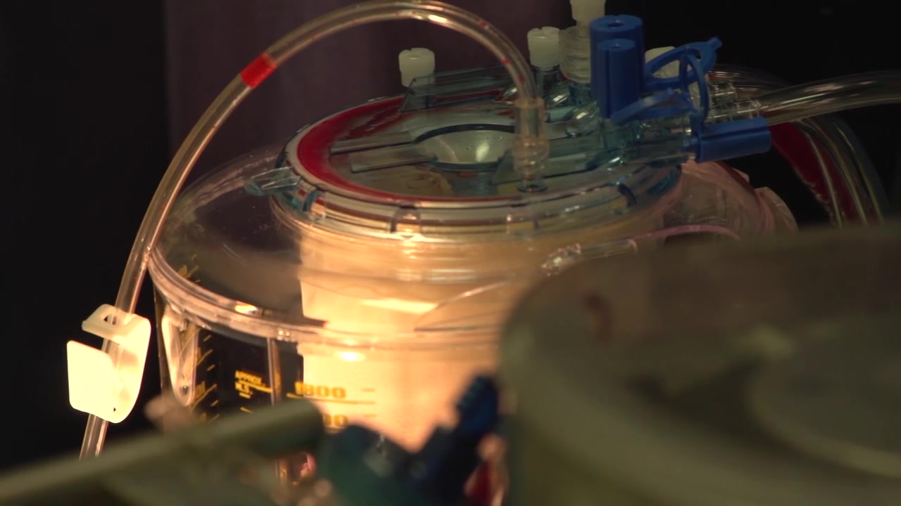 Primo piano di un serbatoio medico in plastica trasparente e tubi di perfusione in funzione all'interno di una sala operatoria ospedaliera, che evidenzia un supporto vitale clinico avanzato o apparecchiature per il riciclo dei fluidi.