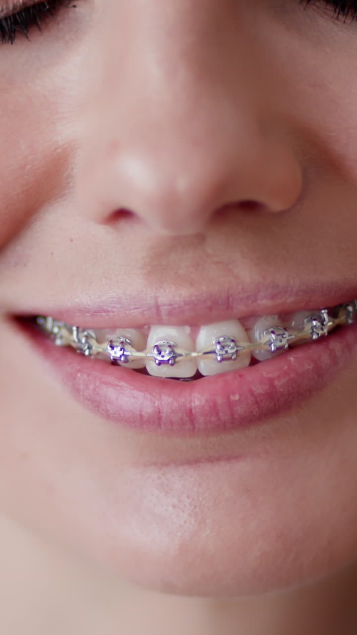 Vertical video closeup of woman smiling with dental braces promotes oral hygiene and confidence