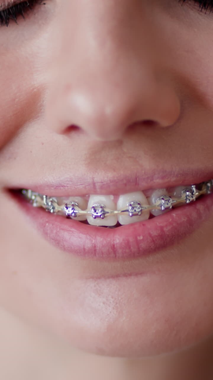 Video verticale ravvicinato di una donna sorridente con apparecchio ortodontico che promuove l'igiene orale e la fiducia in sé stessi