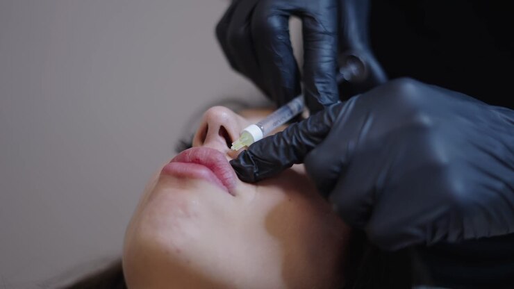 Close-up of a cosmetic lip augmentation procedure with dermal fillers