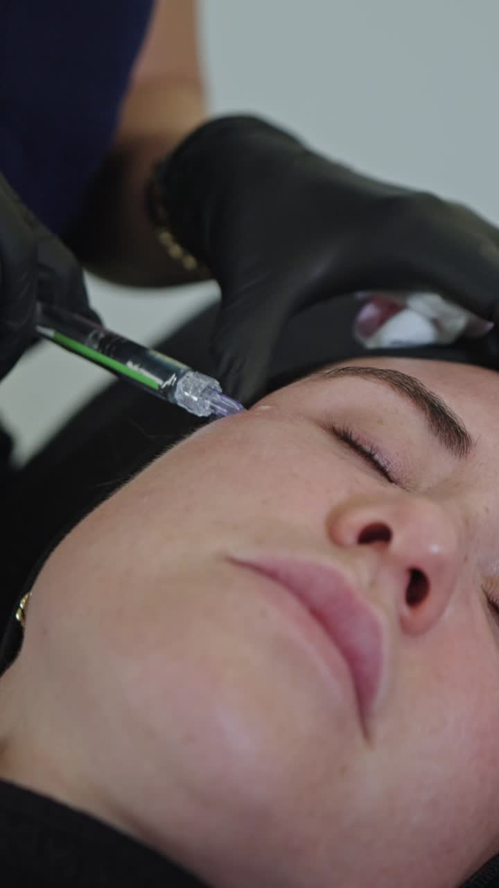 Un professionista medico estetico, con guanti neri sterili, tiene una siringa sottile ed esegue attentamente una precisa iniezione di polinucleotidi nella delicata area periorbitale e sotto gli occhi