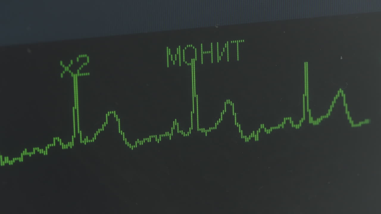 ECG Monitor Display