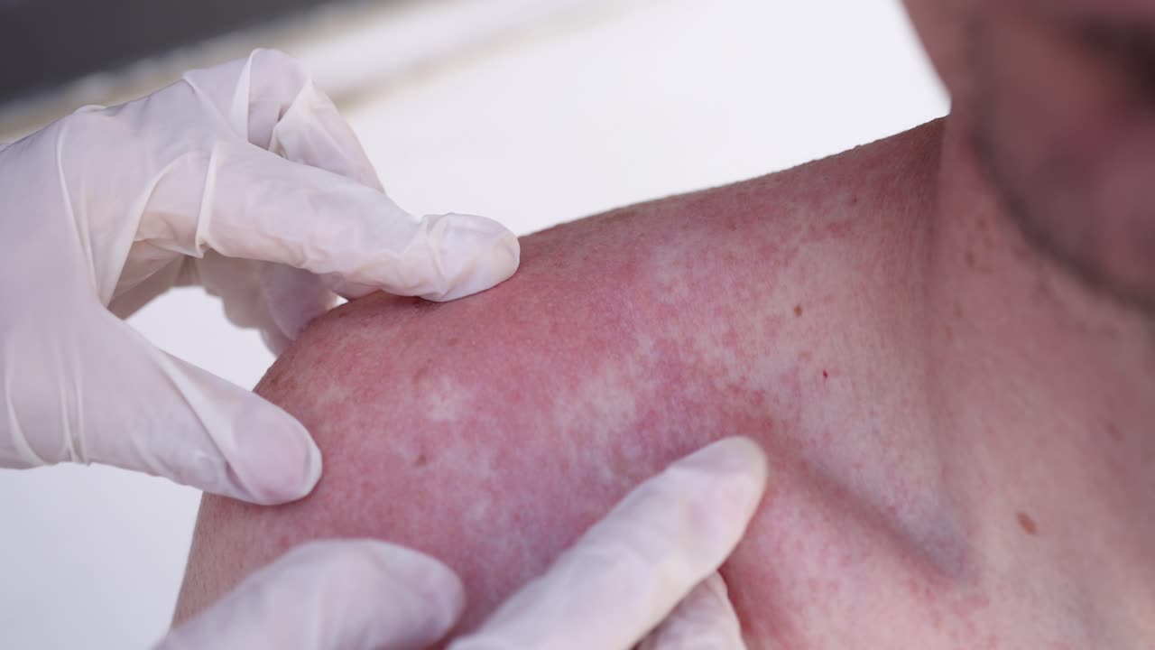 Medico esamina una scottatura solare sulla spalla di un uomo, filmato 4K