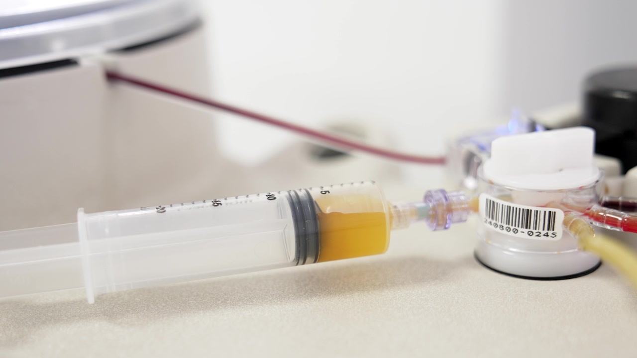 Plasma giallo separato dal sangue che riempie la siringa. Primo piano. Attrezzatura per la preparazione del concentrato per la terapia PRP