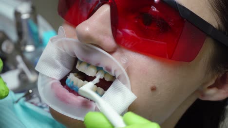 mujer joven con un expansor en la boca en la clínica dental. aplicación de gel blanqueador protector a los dientes. consultorio dental moderno. filmado en 4k