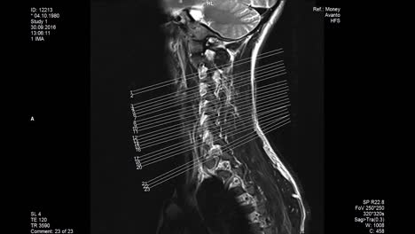 La-Resonancia-Magnética-Escanea-La-Columna-Lumbar-Y-Muestra-Los-Tamaños.