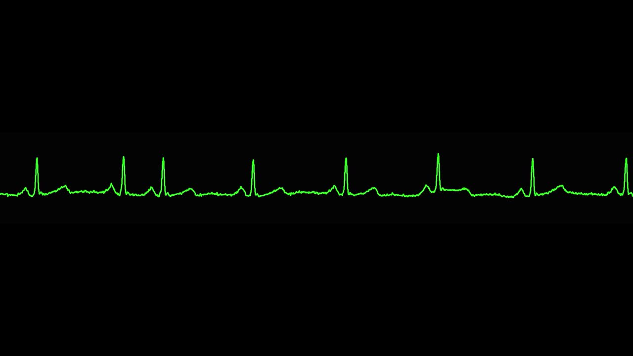 ecg shows normal sinus rhythm
