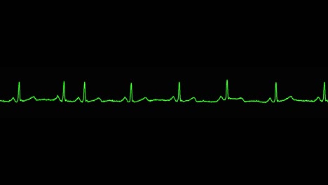 el ecg muestra un ritmo sinusal normal.