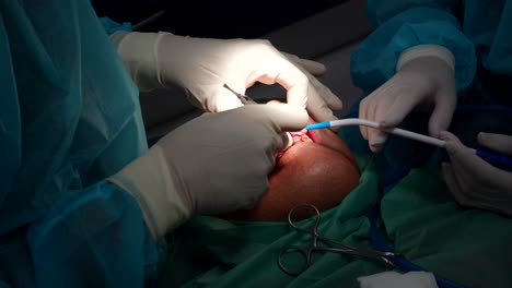 odontólogo cortando la encía del paciente y abriéndola durante una cirugía de extracción de dientes.