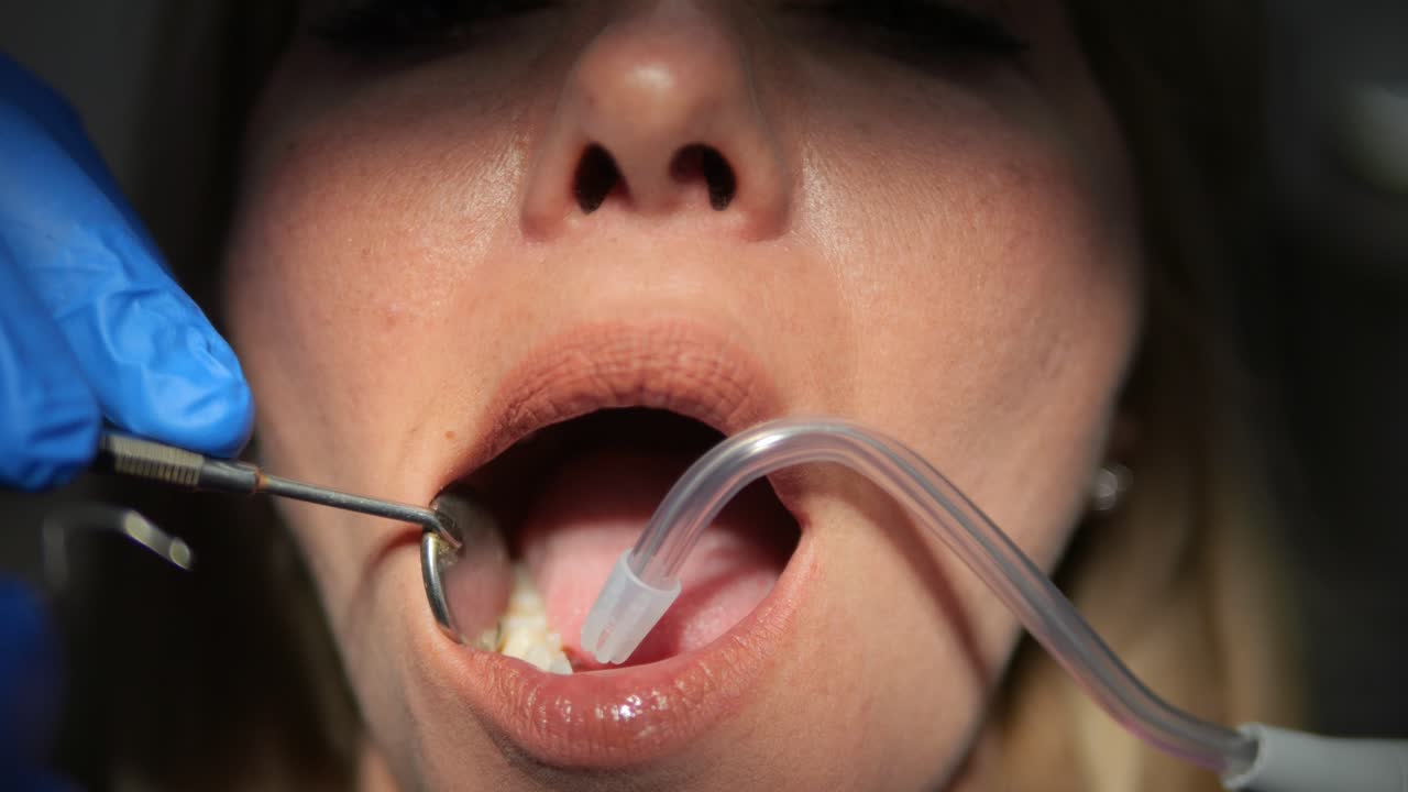 치과 의사는 환자의 치아를 검사하기 위해 의료 도구를 사용합니다. 입을 가게 파란 장갑 치과 정형 치과 의사