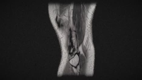 vintage textured mri scan of an injured male knee, after excess basketball playing