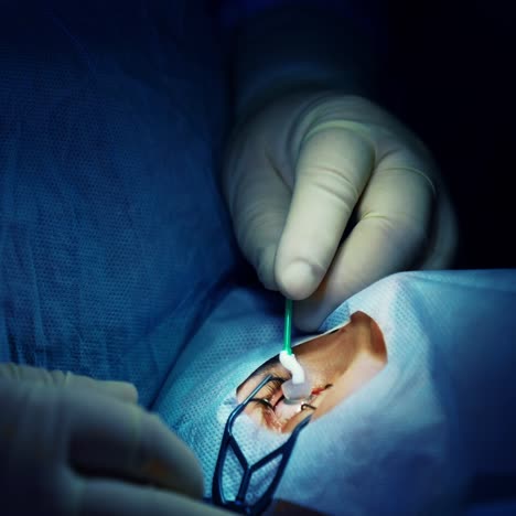 patient under sterile cover. surgeon hands performing laser eye vision correction