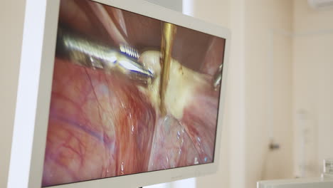 laparoscopic surgical procedure