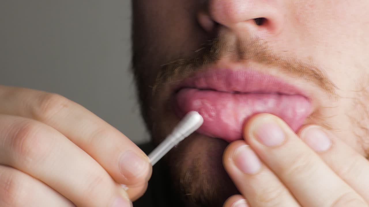 putting healing gel ointment on an aphtha oral inflammation on the gums with a cotton swab