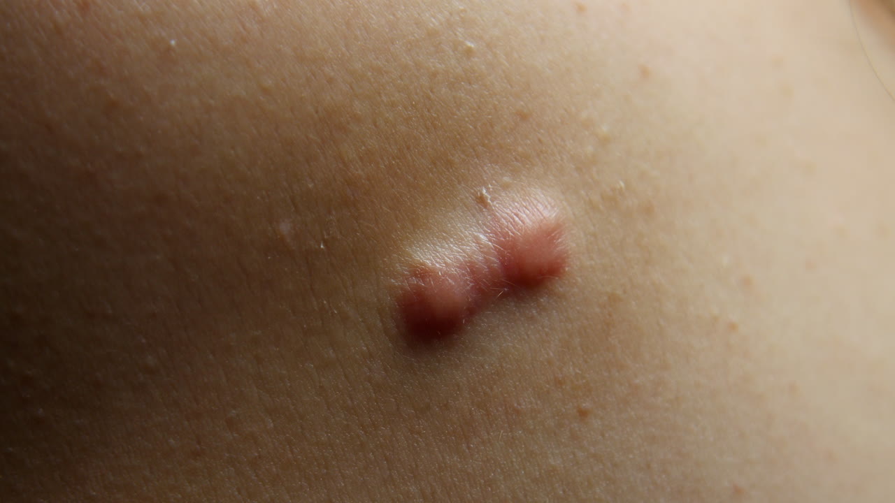 사람이 피부의 키로이드 흉터를 만진 경우