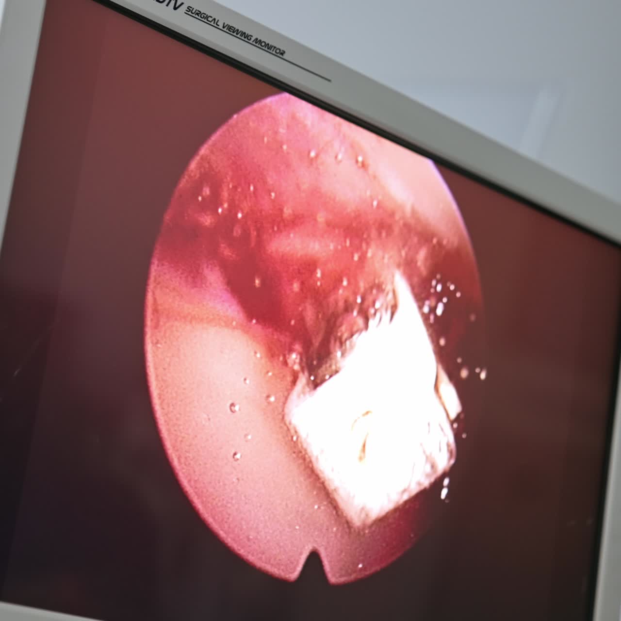 Working screen showing the process of operation. The movement of surgical tools inside the operated organ shot by micro camera. Close up