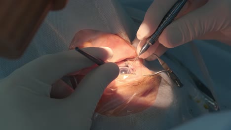 cataract surgery close up. surgeon operating eye cataract in hospital surgery