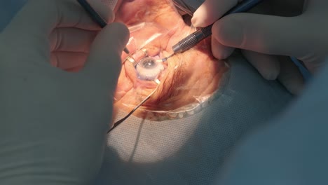 cataract surgery close up. surgeon operating eye cataract in hospital surgery