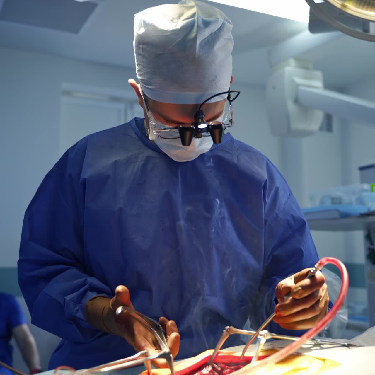 Mandlig neurokirurg leder en operation. Kirurgen holder og anvender specialværktøj under operationen, og røg stiger op fra patientens sår. En assistent rækker kirurgisk tang til lægen.