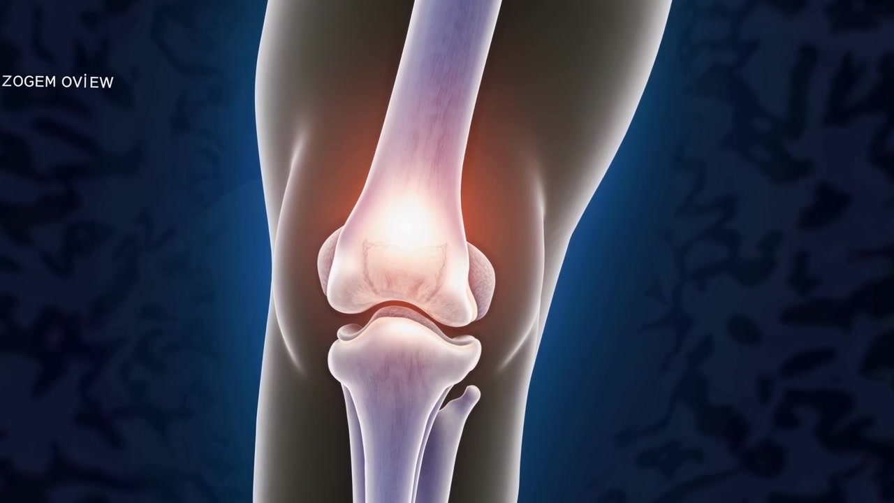 3D Animation of Human Knee Joint with Pain and Inflammation | Premium ...