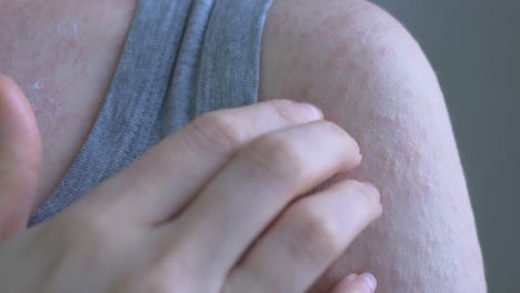 close-up shows the womans right shoulder and the area above the chest. red spots of different sizes on the skin. scratching the spots with your fingertips. viral diseases