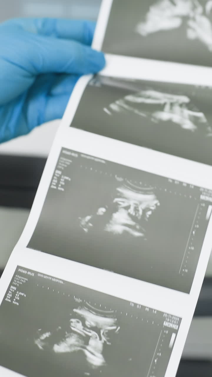 gloved hands holding sonogram printouts emerging from printer, long strip of grayscale fetal images displayed, closeup on prints and fingers in blue gloves, clinic counter and equipment blurred