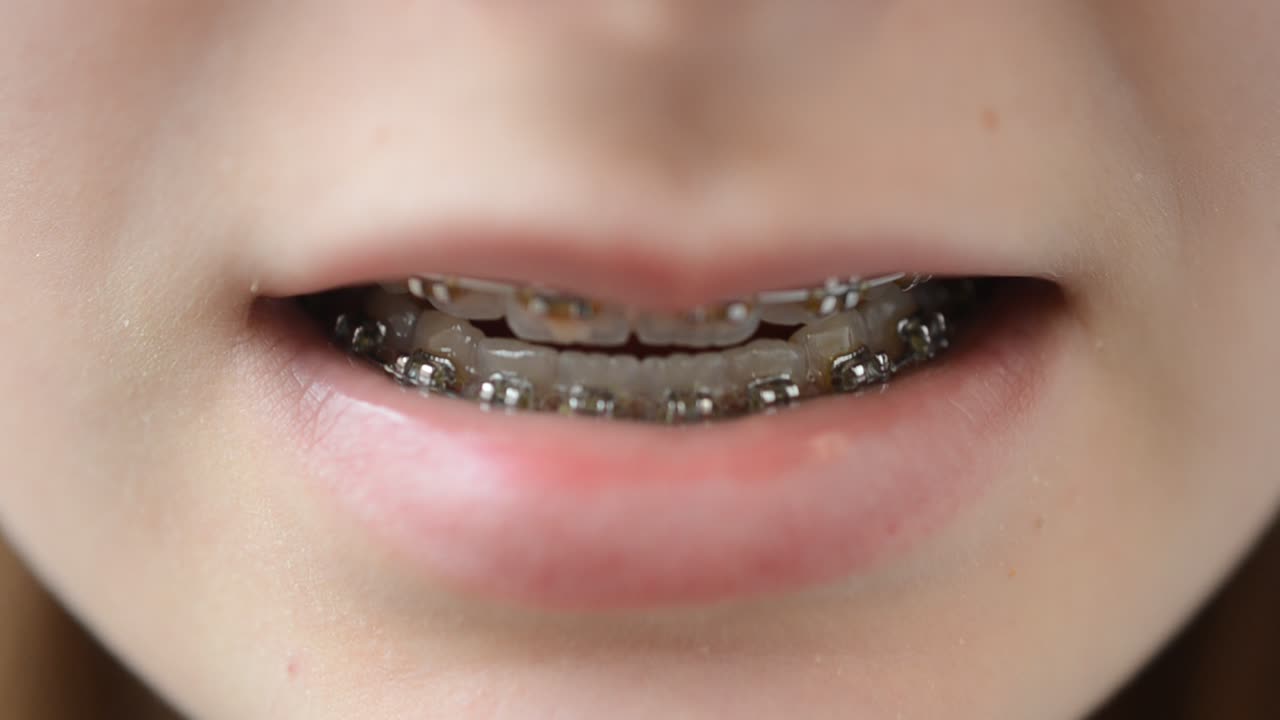 Briquettes on teeth. The girl the teenager in briquettes