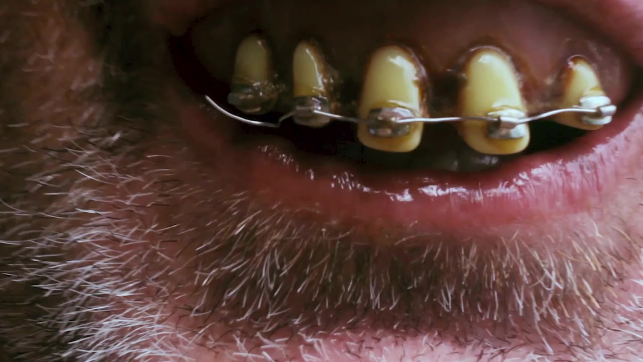 Extreme close up of a creepy old nerd with stained buck teeth and braces that leans in for a kiss.