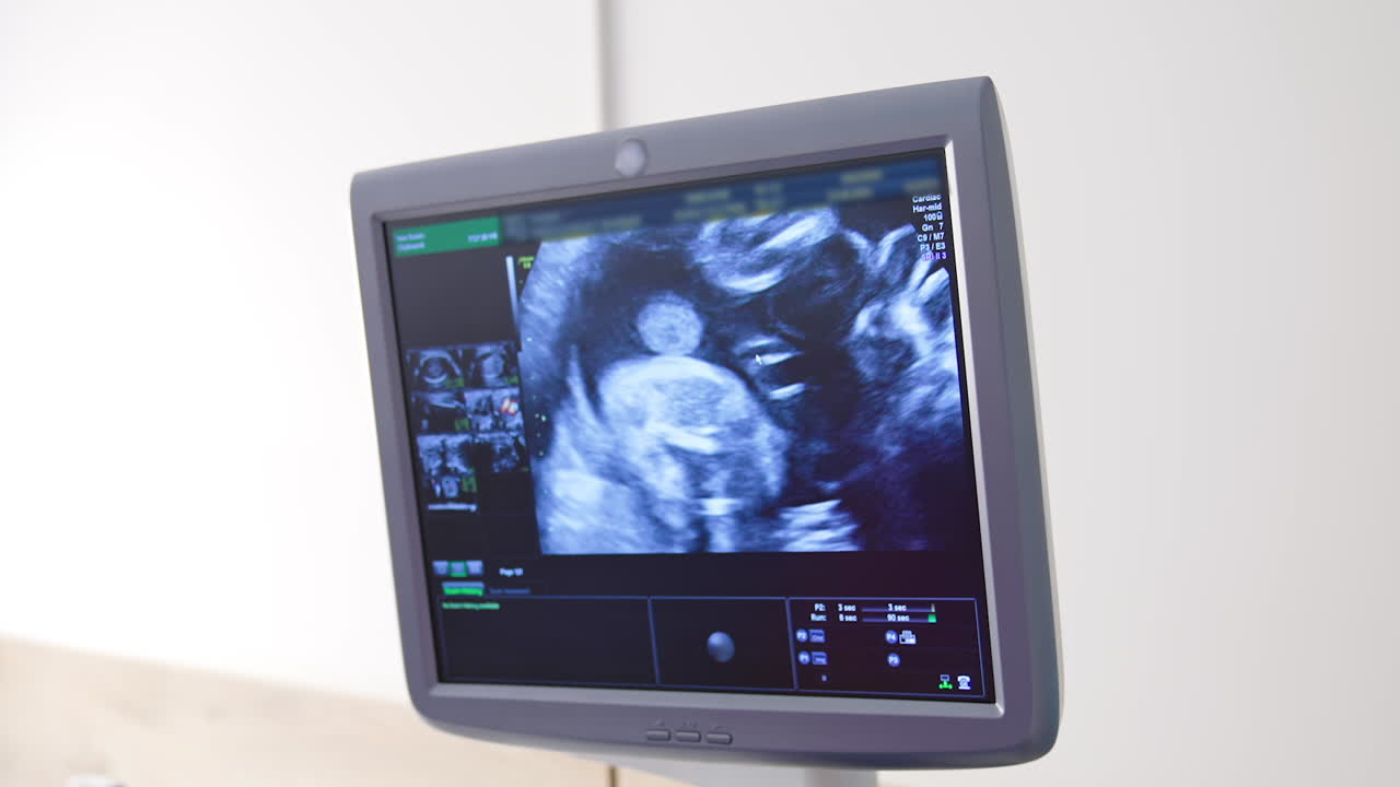 Ultrasound monitor display a small baby. Panning shot of modern ultrasound machine with image of future baby on screen. Development of pregnancy.