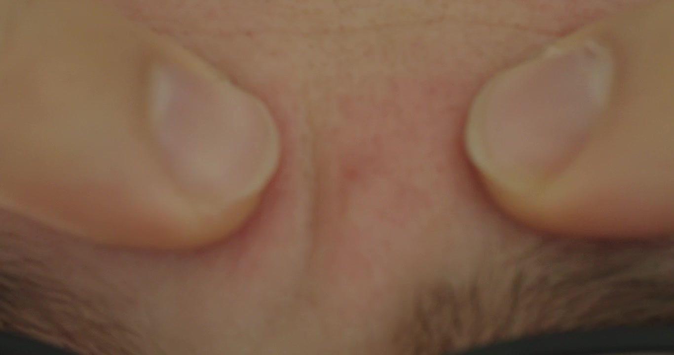 Vista macro estrema di un piccolo brufolo sulla fronte esaminato con le dita. Concetto di acne, cura della pelle, imperfezioni cutanee, dermatologia, cura personale e salute della pelle del viso