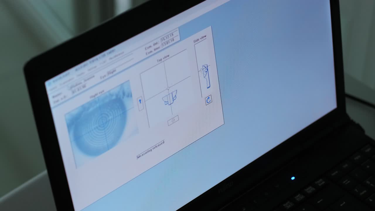cirugía oftalmológica. vista en la pantalla del monitor médico en la sala de operaciones. lasik