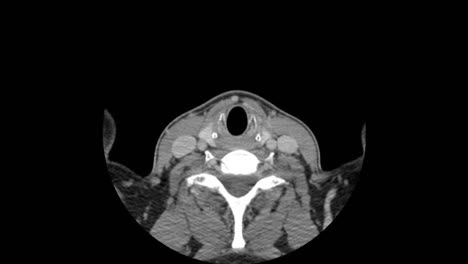 axial ct computed tomography scan layers of head and chest, no text