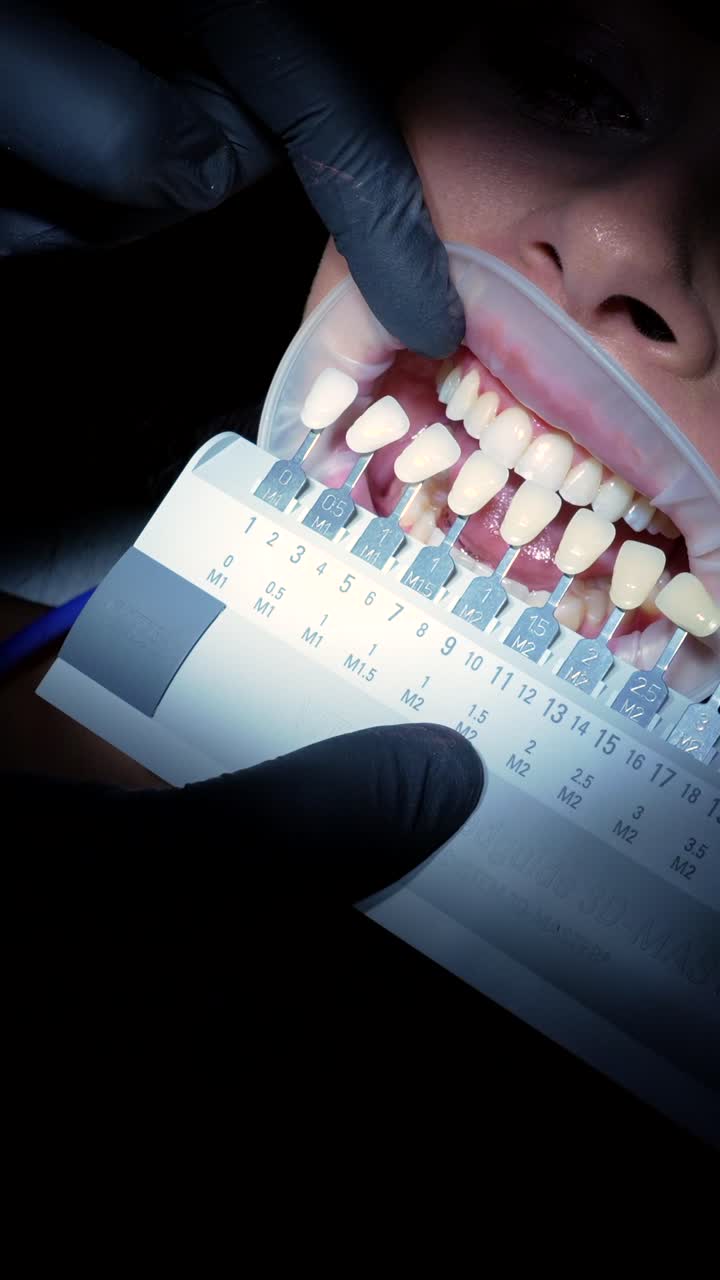 Dental shade matching procedure for teeth whitening