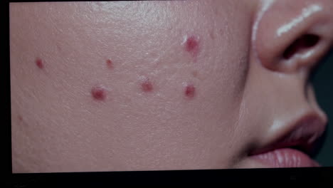 acne on face