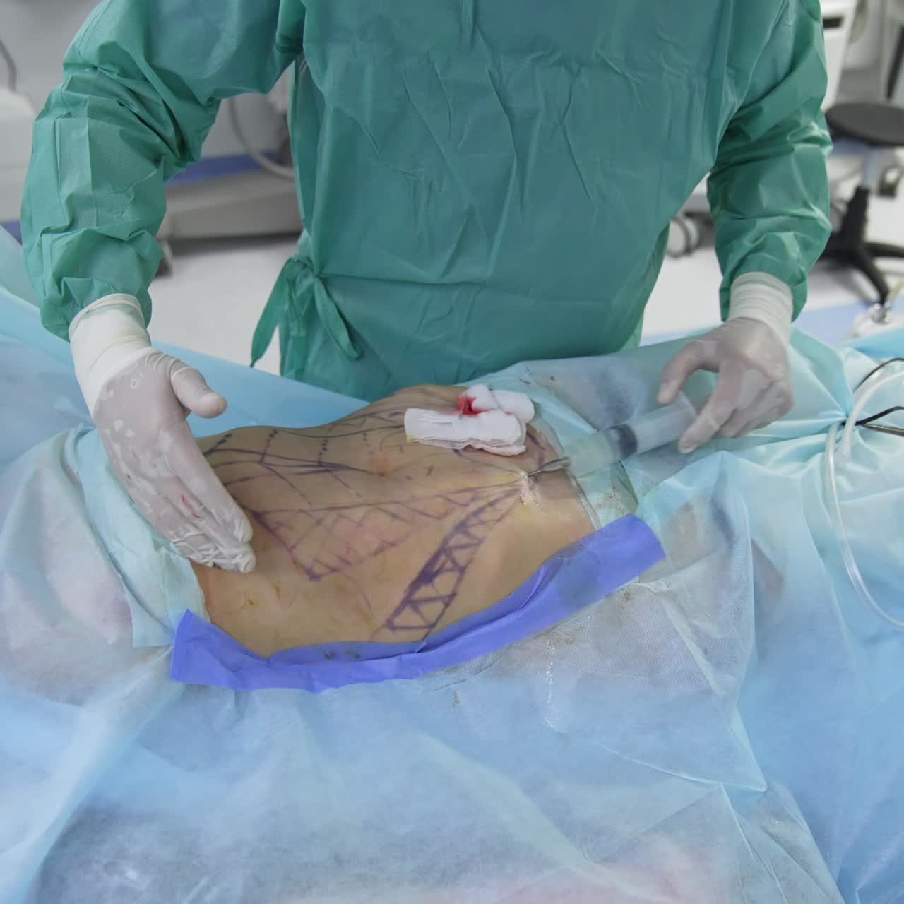 Addome del paziente dopo la procedura di liposuzione. Intervento chirurgico di rimozione del grasso. Chirurgo plastico che sta terminando l'operazione di liposuzione e liposculpture. Corpo del paziente durante l'intervento.