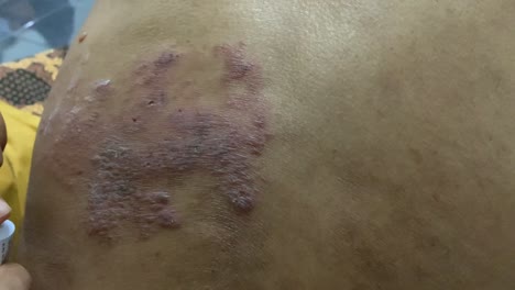 un dedo está aplicando ungüento a la piel que tiene herpes