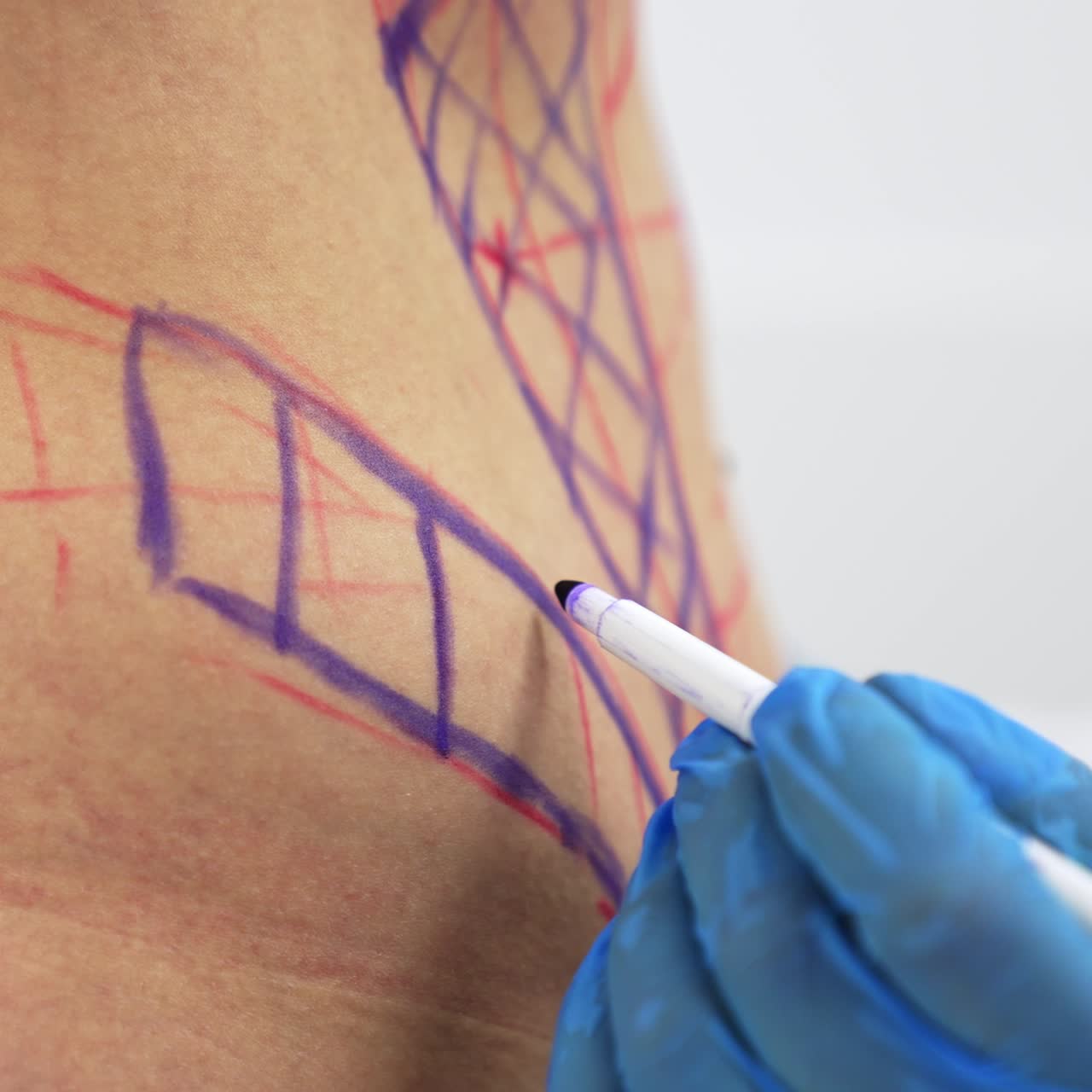 Blue and red lines being drawn on a female stomach. Doctor preparing the patient to the abdominoplastic surgery