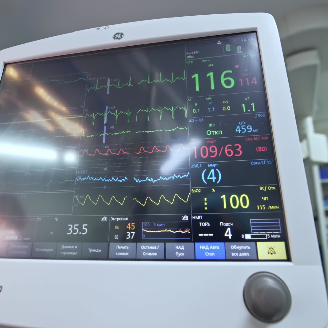 Screen of a lung ventilator showing the life parameters of a person under surgery. Artificial lung ventilator monitor close up
