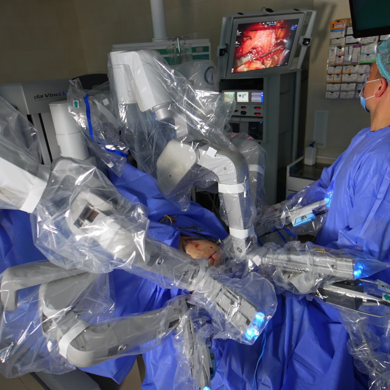 Caucasian surgeon looks at the work of robotic forceps on the screen in front of him. Da Vinci system performing laparoscopic surgery