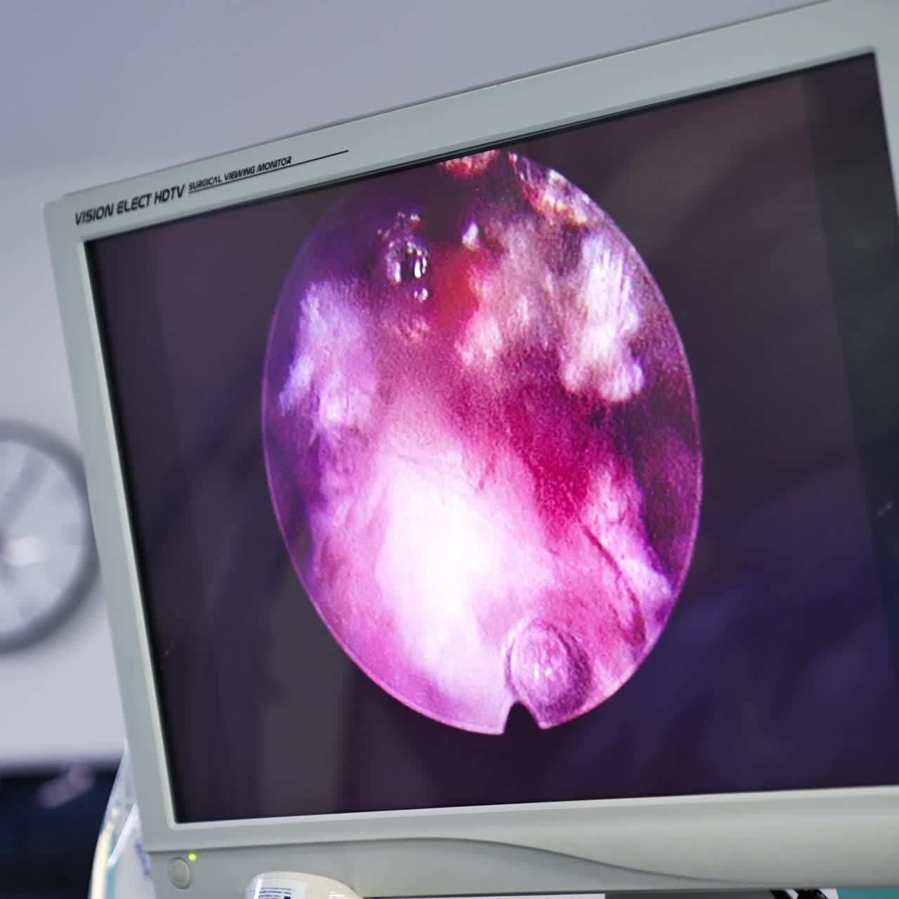 Monitoraggio di interventi di neurochirurgia. Monitoraggio su schermo di operazioni sanitarie