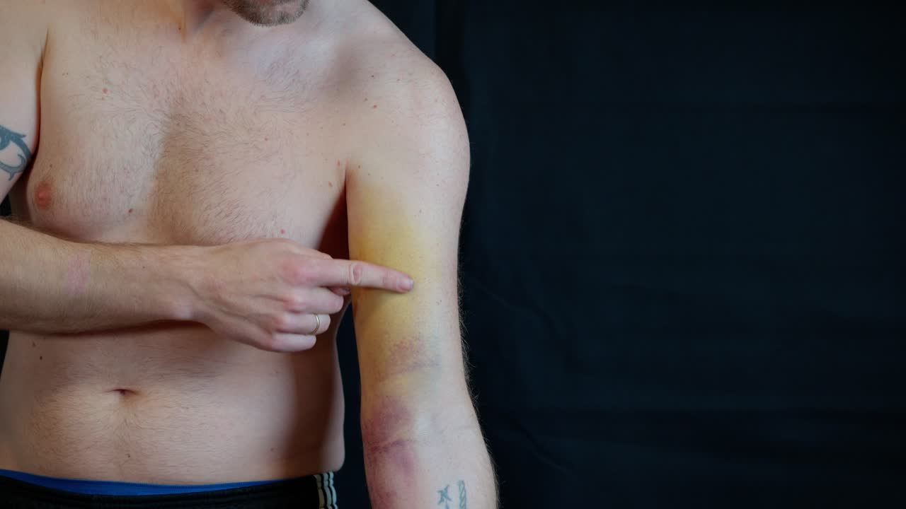 Closeup of a severely bruised biceps and elbow with deep yellow and blue discoloration. Possible muscle tear or tendon damage as arm rests in a dark setting