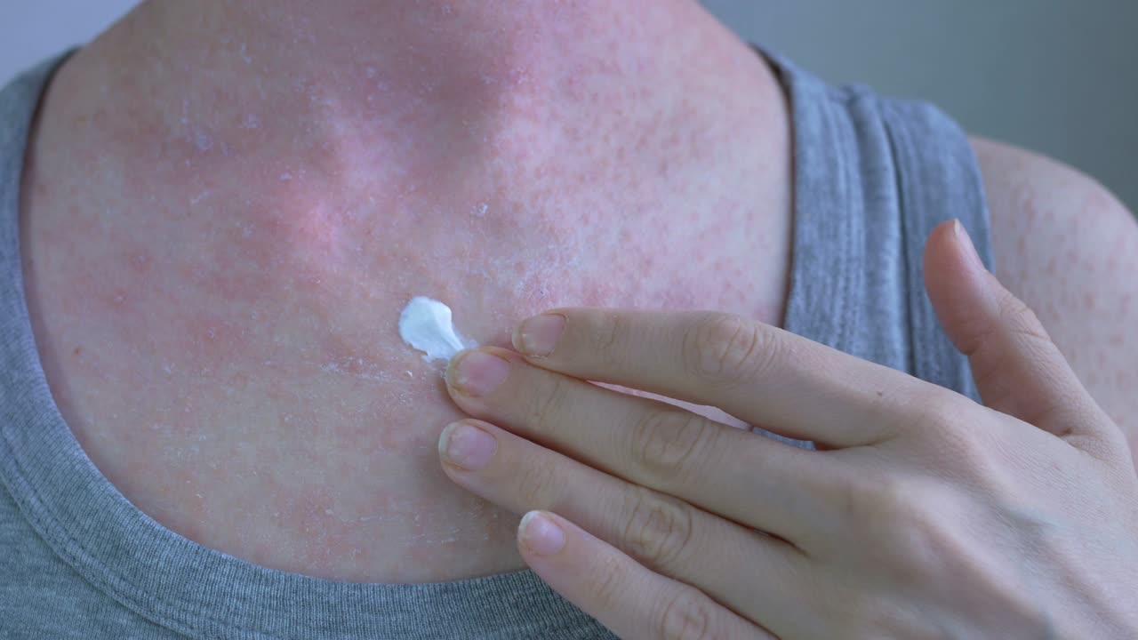 튜브에서 손으로  마늘을 손가락 패드에 압축하는 클로즈업  - 몸에 알레르기 반응이 밝은 은 색으로 흘러나옵니다 - 바이러스 질병 - 피부 가려움증