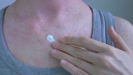 toma de primer plano con una mano de un tubo apretando un ungüento blanco en la almohadilla de un dedo. en el cuerpo, una reacción alérgica se derrama en un color rojo claro. enfermedades virales. picazón en la piel