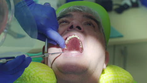 proceso de extirpación del diente de caries. cerca de las manos del dentista extirpando el diente enfermo