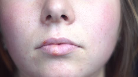 close-up of lip sores