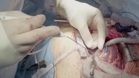 medical staff of the operating unit do heart surgery shunt installation