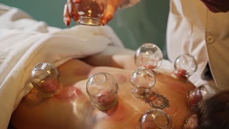 therapist applying and removing cupping suction cups to patients back