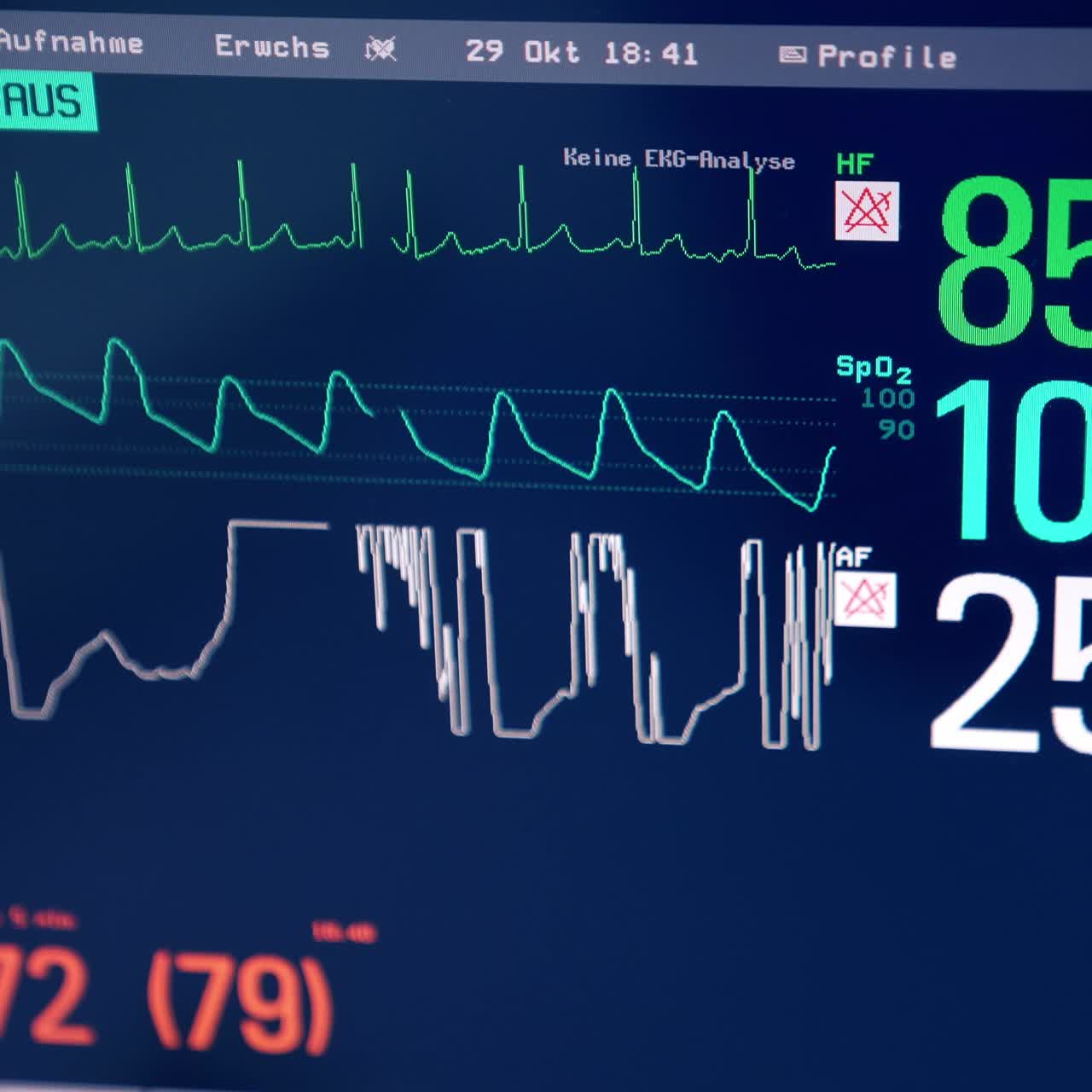Screen of medical equipment showing life parameters of a patient at operation. Close up. Blur at the end of video