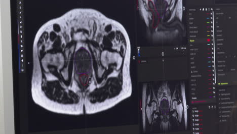 pelvic mri scan