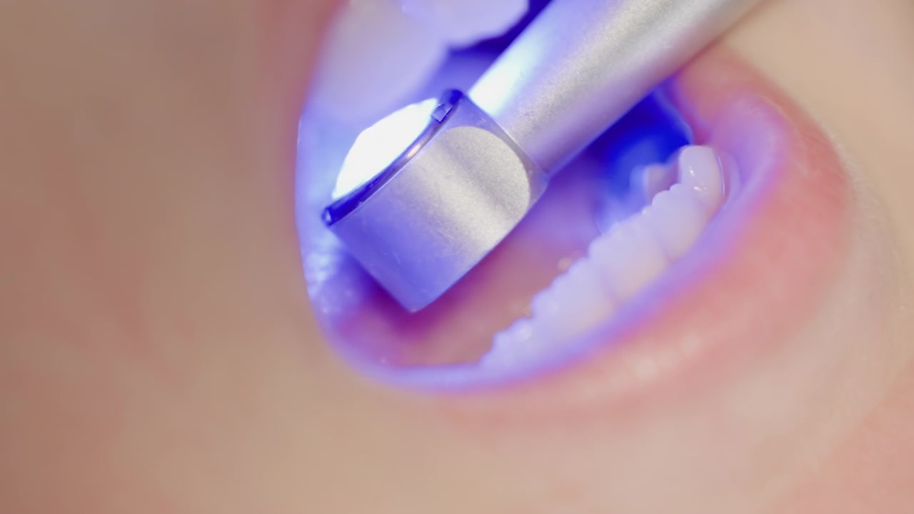 Primo piano di un professionista dentale che utilizza attrezzature specializzate per pulire e lucidare i denti durante una procedura ortodontica. Lo strumento metallico si muove metodicamente attraverso la bocca, evidenziando la precisione.